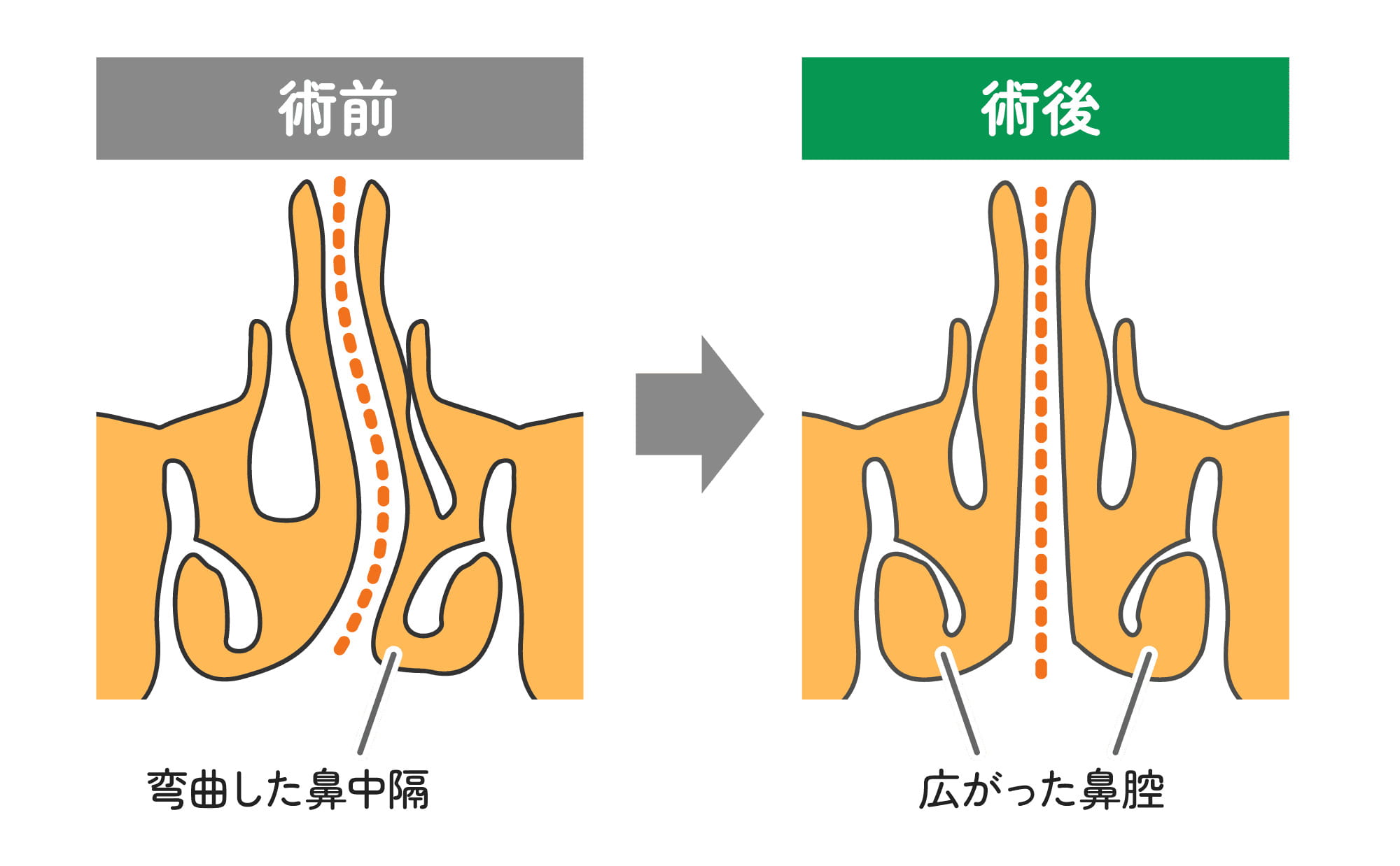 鼻中隔矯正術とは